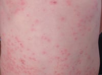 Gwent measles outbreak is over 