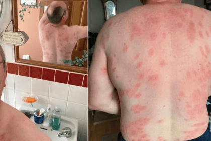 Brecon man survives more than 160 wasp stings thanks to MIU nurses